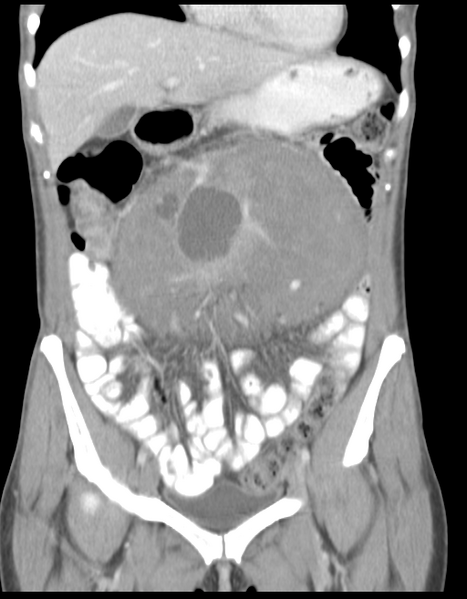 File:Abdominal desmoid tumor (Radiopaedia 41007-43740 Coronal C+ portal venous phase 15).png