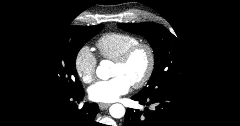 File:Aberrant left main coronary artery (ALMCA) arising from the right sinus with interarterial course (Radiopaedia 63251-71814 Axial C+ arterial phase 87).JPG
