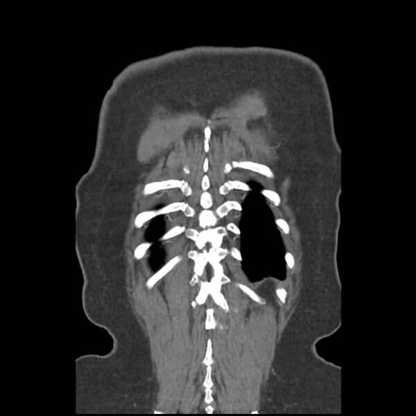 File:Aberrant right subclavian and left vertebral arteries (Radiopaedia 43467-46847 Coronal C+ portal venous phase 80).jpg