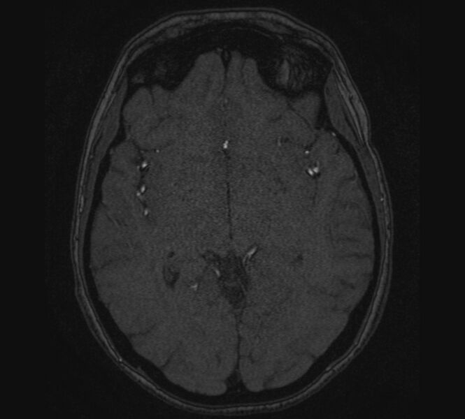 File:Accessory middle cerebral artery and ICA aneurysm (Radiopaedia 22656-22674 MRA 68).jpg