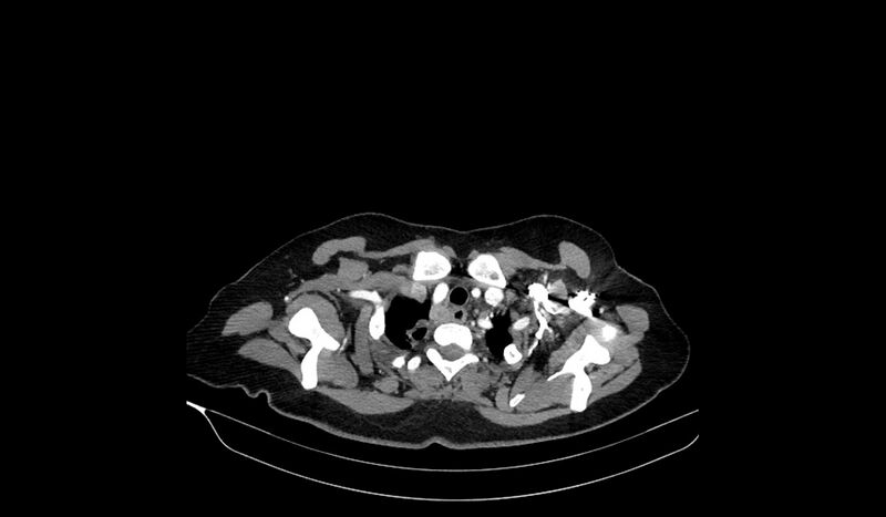 File:Acquired tracheo-esophageal fistula (Radiopaedia 51356-57103 Axial C+ arterial phase 15).jpg