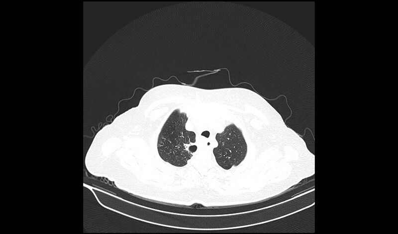 File:Acquired tracheo-esophageal fistula (Radiopaedia 51356-57103 Axial lung window 7).jpg