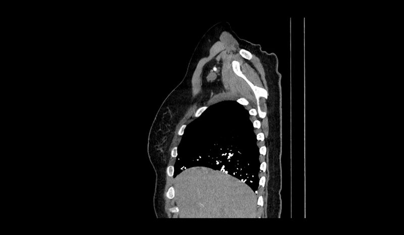 File:Acquired tracheo-esophageal fistula (Radiopaedia 51356-57103 Sagittal C+ arterial phase 16).jpg
