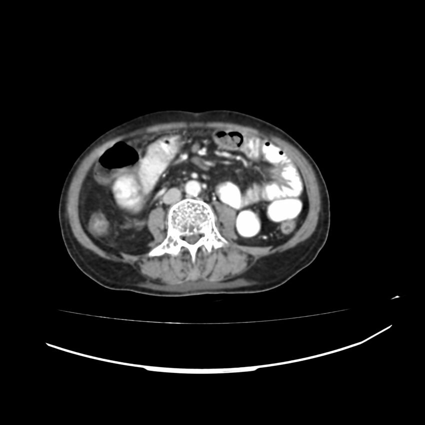 Acute-on-chronic Crohn disease with enteroenteric fistula (Radiopaedia 66686-75987 B 7).jpg