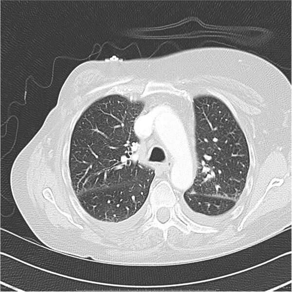 File:Acute-on-chronic pulmonary emboli (Radiopaedia 27925-28169 lung window 16).jpg