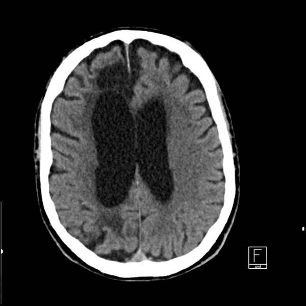 File:Acute ICA ischemic penumbra due to high-grade CCA stenosis (CT perfusion) (Radiopaedia 72038-82529 Axial non-contrast 31).jpg