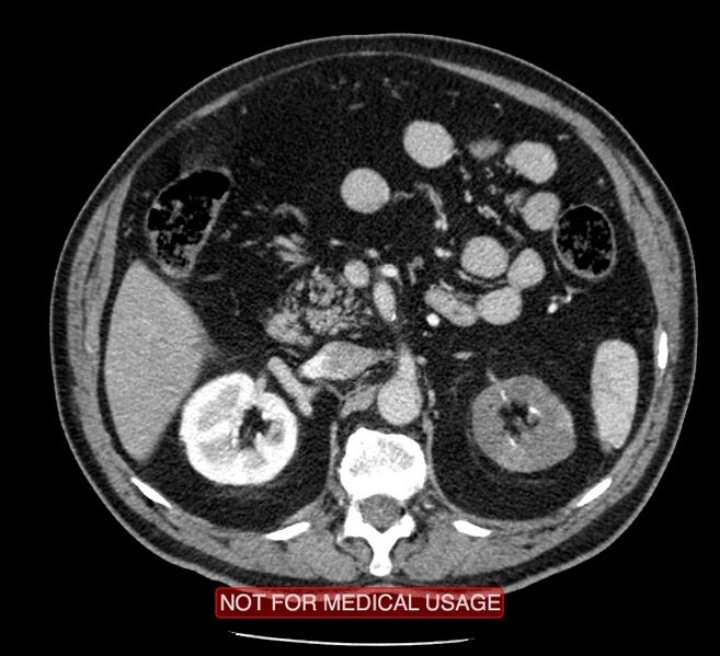 File:Acute aortic dissection - Stanford type A (Radiopaedia 40661-43285 Axial C+ portal venous phase 94).jpg