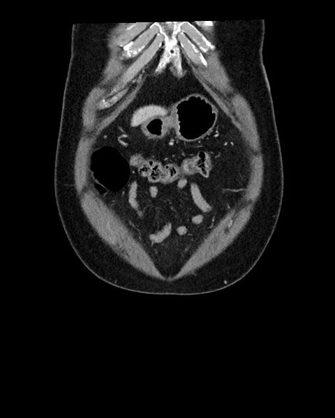 File:Acute appendicitis - large appendicoliths (Radiopaedia 61805-69820 Coronal C+ portal venous phase 22).jpg