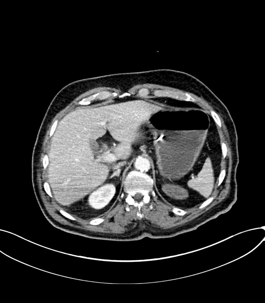 Acute arterial mesenteric ischemia (Radiopaedia 78238-90828 Axial C+ portal venous phase 34).jpg
