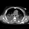 Acute aspiration pneumonitis (Radiopaedia 33605-34703 Axial non-contrast 41).jpg