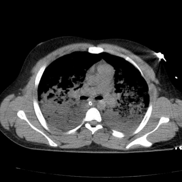 File:Acute aspiration pneumonitis (Radiopaedia 33605-34703 Axial non-contrast 41).jpg