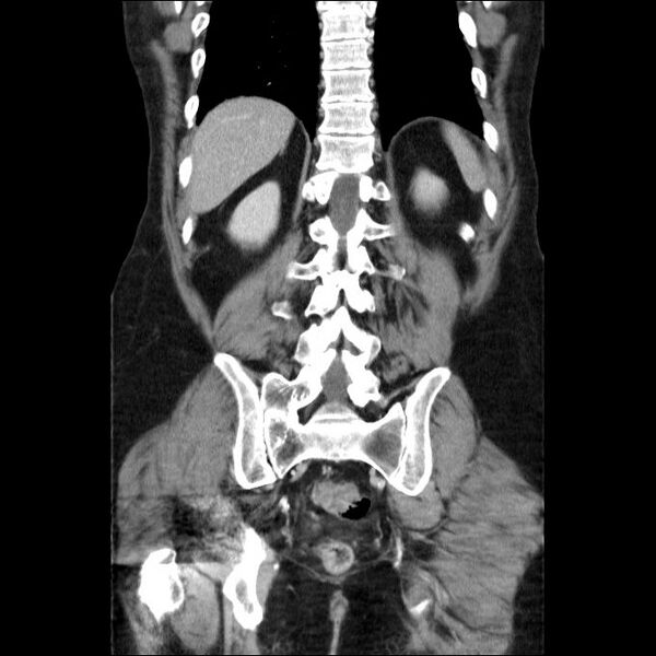 File:Acute cholecystitis and incidental left sided IVC (Radiopaedia 49352-54459 Coronal C+ portal venous phase 20).jpg