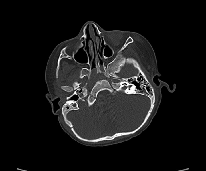 File:Acute hemorrhagic contusion (Radiopaedia 63660-72336 Axial bone window 15).jpg