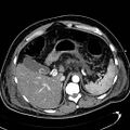Acute pancreatic necrosis (Radiopaedia 13560-13486 Axial C+ portal venous phase 40).jpg