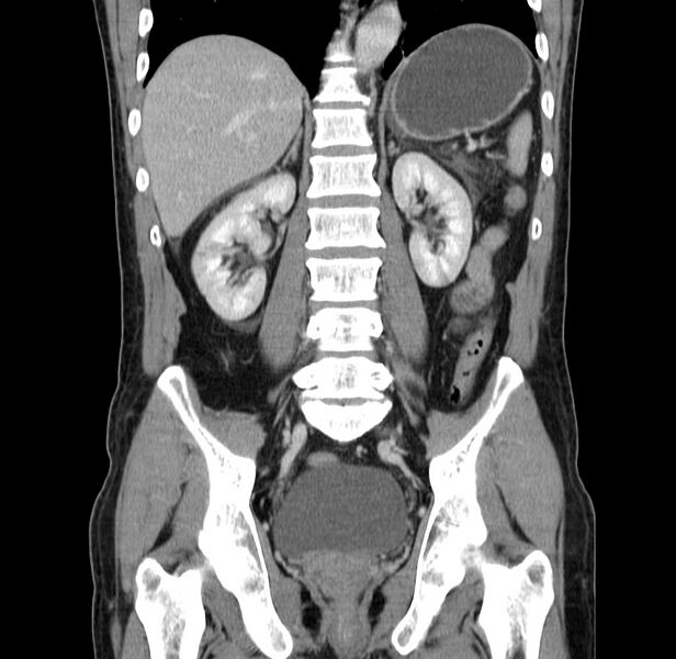 File:Acute pancreatitis (Radiopaedia 22572-22596 Coronal C+ portal venous phase 35).jpg