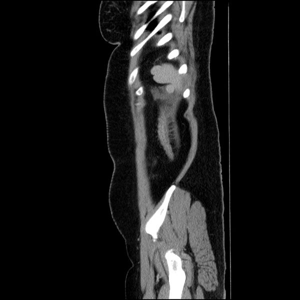 File:Acute pancreatitis (Radiopaedia 69236-79012 Sagittal C+ portal venous phase 22).jpg