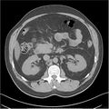 Acute pancreatitis - mild (Radiopaedia 27796-28033 Axial non-contrast 17).jpg