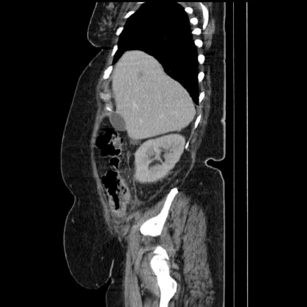 File:Acute pyelonephritis (Radiopaedia 25657-25837 Sagittal renal parenchymal phase 23).jpg