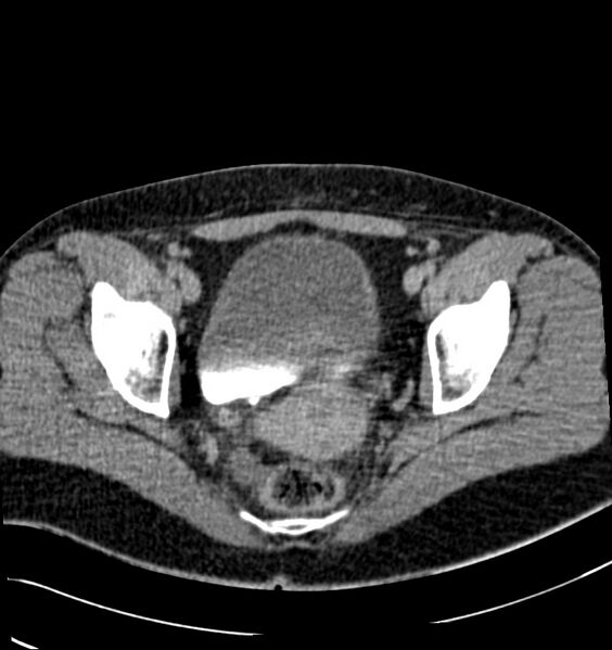 File:Acute pyelonephritis (Radiopaedia 40264-42816 Axial renal excretory phase 32).jpg