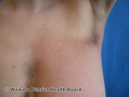 Acute radiation dermatitis