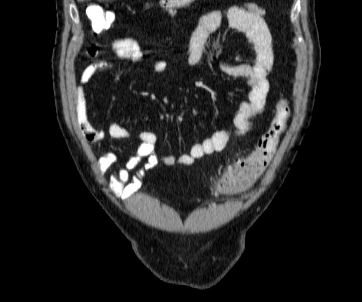 File:Acute sigmoid colon diverticulitis (Radiopaedia 55507-61976 Coronal C+ portal venous phase 18).jpg