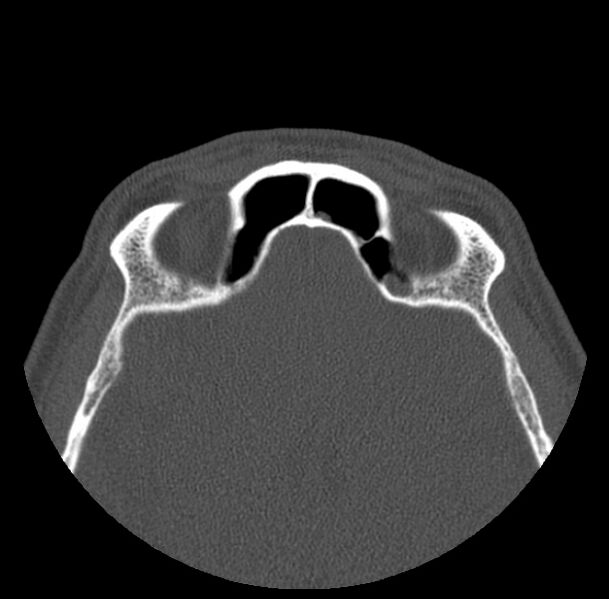 File:Acute sinusitis (Radiopaedia 23161-23215 Axial bone window 63).jpg