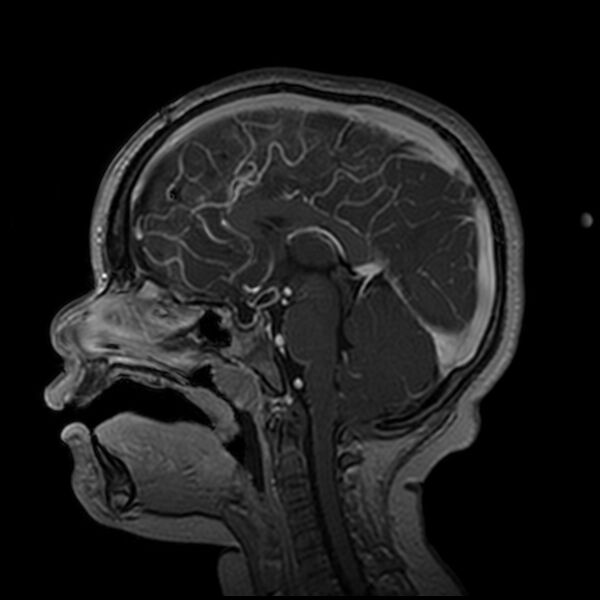 File:Adamantinomatous craniopharyngioma (Radiopaedia 77407-89529 H 61).jpg