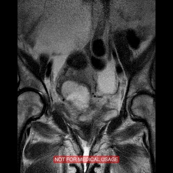 File:Adenocarcinoma of the cervix (Radiopaedia 28373-28615 Coronal T2 9).jpg