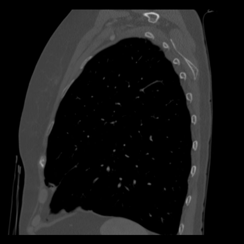 Adenocarcinoma of the lung (Radiopaedia 41015-43755 Sagittal bone window 85).jpg