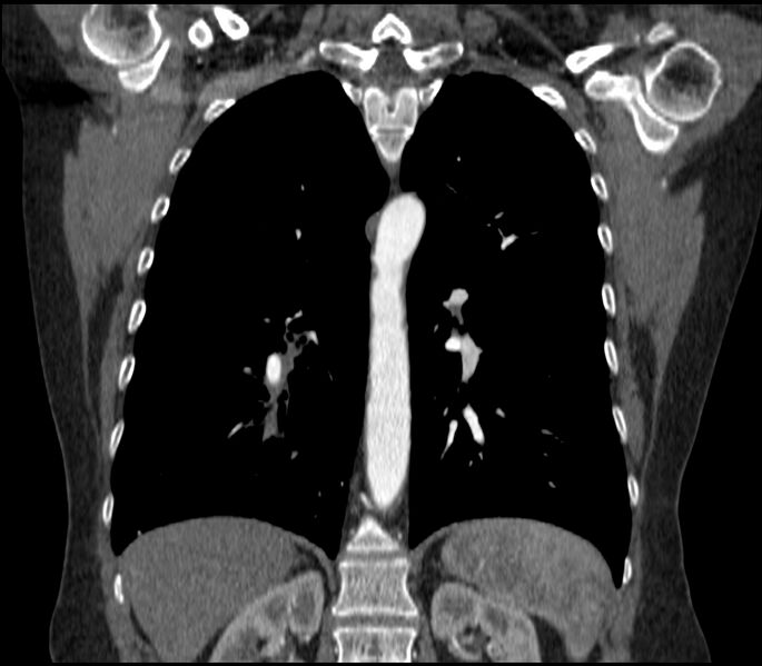 File:Adenocarcinoma of the lung (Radiopaedia 44205-47803 Coronal C+ portal venous phase 61).jpg