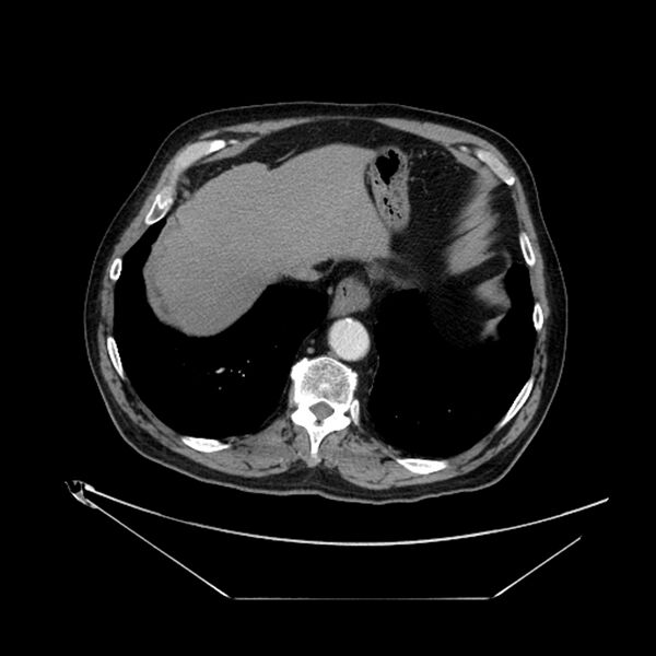 File:Adenocarcinoma of the lung (Radiopaedia 44876-48759 Axial C+ portal venous phase 69).jpg