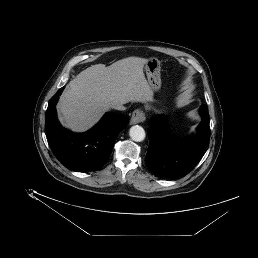 Adenocarcinoma of the lung (Radiopaedia 44876-48759 Axial C+ portal venous phase 69).jpg
