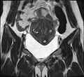 Adenomyosis - ovarian endometriomas (Radiopaedia 67031-76350 Coronal T2 9).jpg