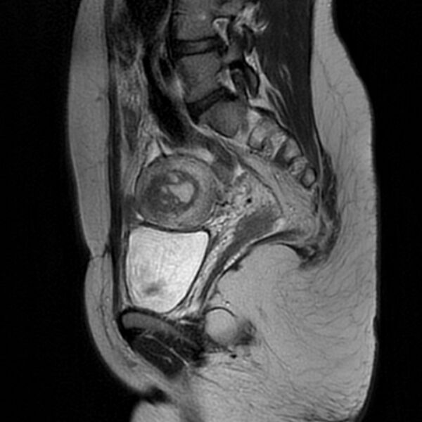 File:Adenomyosis within a septate uterus (Radiopaedia 69963-79981 Sagittal T2 12).jpg