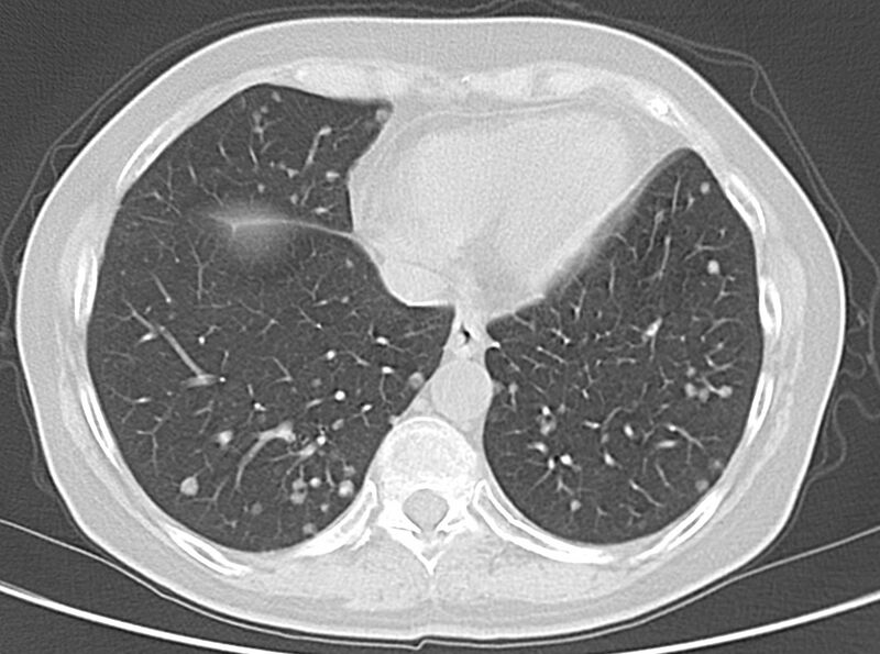 File:Adenosquamous lung carcinoma (Radiopaedia 22035-22030 lung window 45).jpg