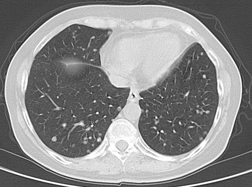 Adenosquamous lung carcinoma (Radiopaedia 22035-22030 lung window 45).jpg
