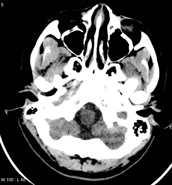 File:Aicardi syndrome (Radiopaedia 5353-7116 Axial non-contrast 2).jpg