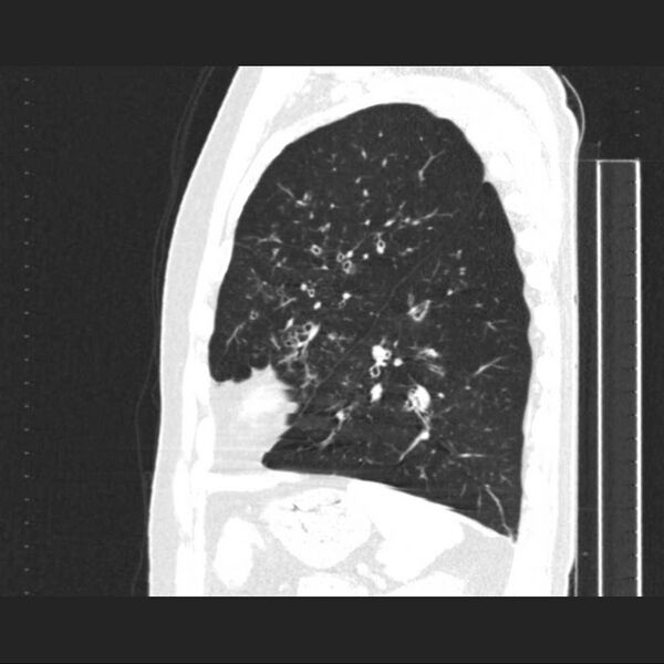 File:Allergic bronchopulmonary aspergillosis (Radiopaedia 21386-21320 Sagittal lung window 5).jpg