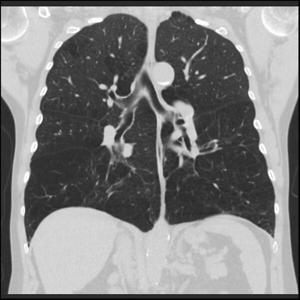 File:Alpha-1-antitrypsin deficiency (Radiopaedia 40993-43722 Coronal lung window 58).jpg