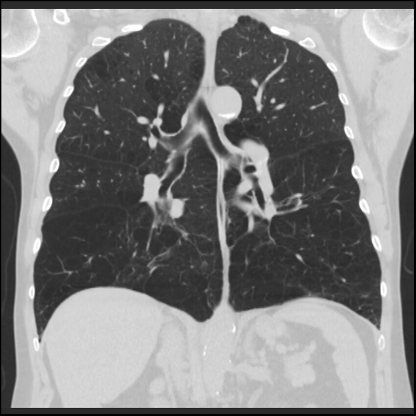 Alpha-1-antitrypsin deficiency (Radiopaedia 40993-43722 Coronal lung window 58).jpg