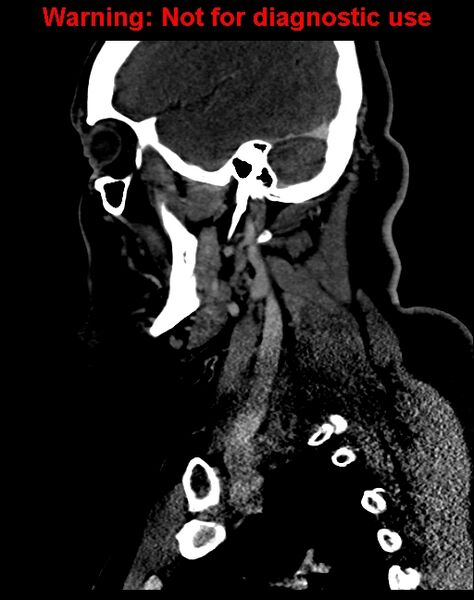 File:Ameloblastoma (Radiopaedia 33126-34164 F 51).jpg