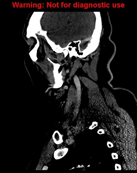 File:Ameloblastoma (Radiopaedia 33126-34164 F 53).jpg