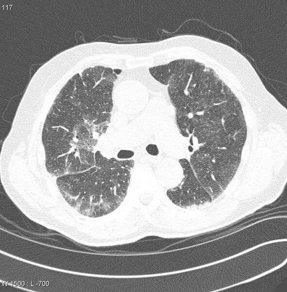 File:Amiodarone lung (Radiopaedia 6539-7851 Axial lung window 12).jpg