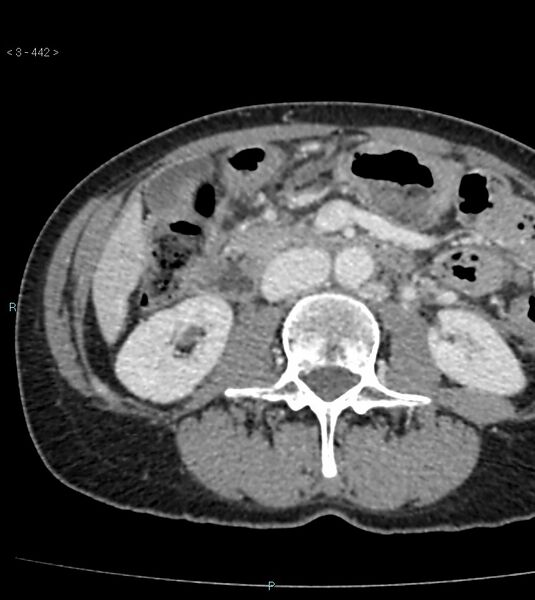 File:Ampulla of Vater metastasis (Radiopaedia 27820-28065 A 46).jpg