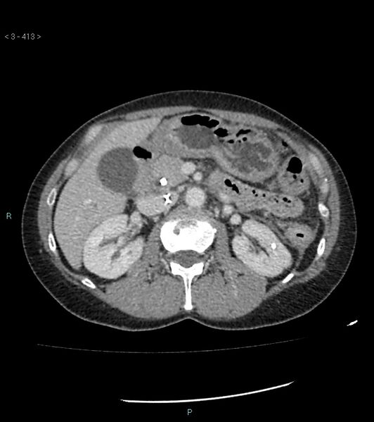 File:Ampulla of Vater metastasis (Radiopaedia 27820-28069 A 51).jpg