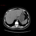 Ampullary carcinoma (Radiopaedia 56396-63056 Axial non-contrast 10).jpg
