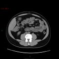 Ampullary carcinoma (Radiopaedia 56396-63056 Axial non-contrast 29).jpg