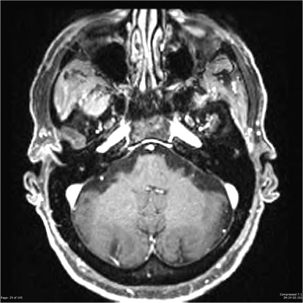 File:Anaplastic meningioma with recurrence (Radiopaedia 34452-35788 Axial T1 C+ 29).jpg