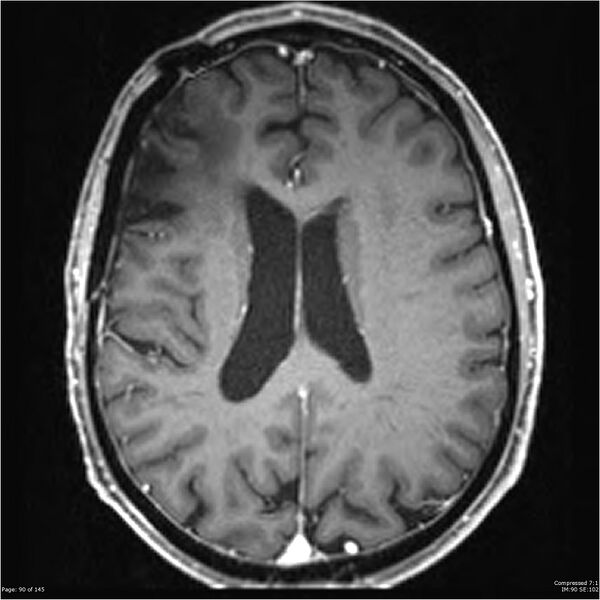 File:Anaplastic meningioma with recurrence (Radiopaedia 34452-35788 Axial T1 C+ 90).jpg