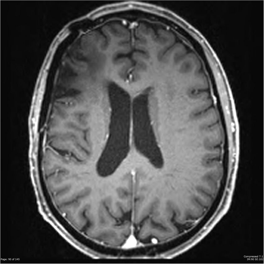 Anaplastic meningioma with recurrence (Radiopaedia 34452-35788 Axial T1 C+ 90).jpg